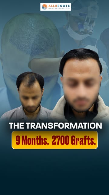 9 Months. 2,700 Grafts. From receding to restored.

A natural-looking hairline. Better coverage. A t