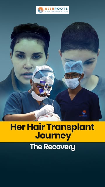 Is a female hair transplant painful? 👀

She shares her real hair transplant recovery experience—fro