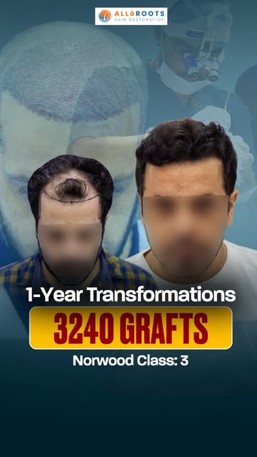 Real Patient. Real Transformation.

3,240 grafts | Advanced FUE Hair Transplant | Dr. Alok Sahoo (MD