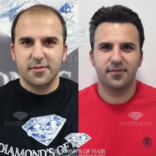 💎 @mesutaydogdu

Diamond’s of Hair 
Hair Transplant Center

With a team of 12+ years of experience 