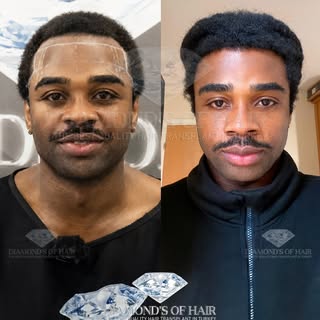 💎 @chuks_obu 

Diamond’s of Hair 
Hair Transplant Center

With a team of 12+ years of experience an