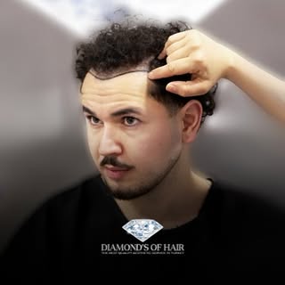💎 Diamond’s of Hair 
Hair Transplant Center

With a team of 12+ years of experience and more than 1