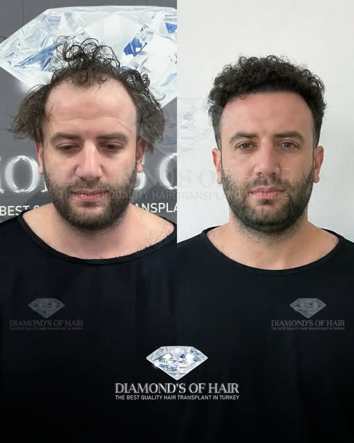 💎 @ikizbroski

Diamond’s of Hair 
Hair Transplant Center

With a team of 12+ years of experience an