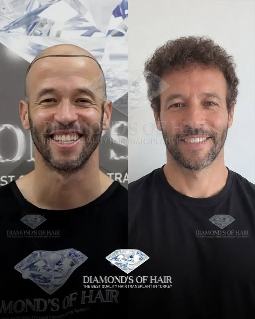 💎 Diamond’s of Hair 
Hair Transplant Center

With a team of 12+ years of experience and more than 1