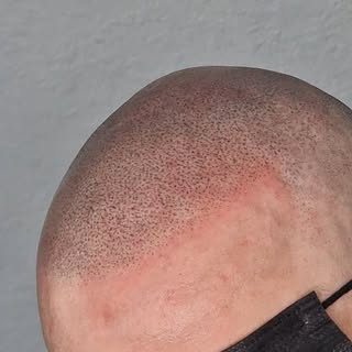 ®️

Just replicating hair follicles in the finest fashion ✨️ 

Dm me if interested ☺️ 

#hairtattoo 