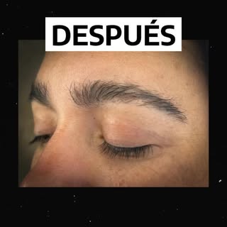 El implante de cejas es una solución definitiva para quienes buscan más densidad, forma y naturalida