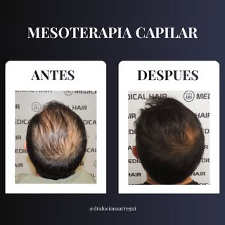 Recuperar el cabello también es recuperar confianza.

La mesoterapia capilar ayuda a fortalecer, est