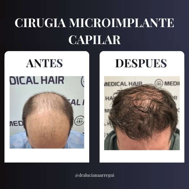La pérdida de cabello es una preocupación común, pero hoy en día contamos con técnicas avanzadas y p