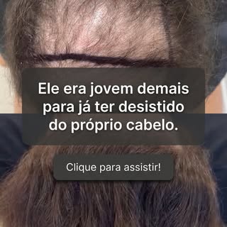 O Lucas chegou até nós muito jovem, mas com uma calvície já extremamente avançada.

Naquela época, o