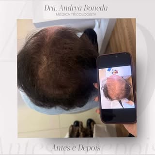 Ele chegou ao consultório, trazendo uma história comum a muitos homens: a calvície avançando. 

Mas 