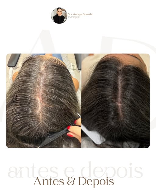 A paciente chegou ao consultório com uma queixa muito comum: queda de cabelo e redução da densidade 