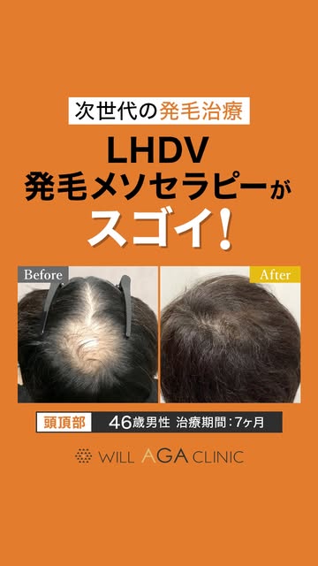 ＼発毛症例をご紹介いたします🌱／

40代男性の患者様症例です👨‍⚕️

当院でLHDV発毛メソセラピーを行い、
7ヶ月でかなり発毛を実感いただきました。

ウィルAGAクリニックは、
【LHDV