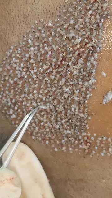 Sapphire Hair Transplant | Your New Hair Story Begins Here .Major Transformation loading.Precision i