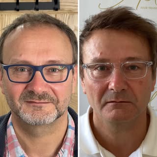 We’re thrilled to have welcomed George back to the clinic just over two years since his 5,499 graft 