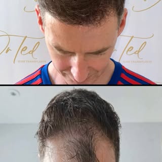 Lovely to welcome to David back to the clinic for his 15-month post-hair transplant review. 

@drted