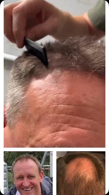 Here’s a nice video comb-through of Grant’s hair transplant results after two surgeries (3,200 graft