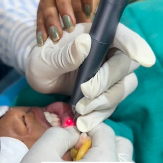 At Siddhi Skin Clinic, we offer advanced CO₂ Laser removal of oral mucoceles, providing:
✅ Precise a