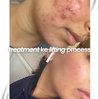At Siddhi Skin Clinic, we offer personalized CO₂ Laser treatments designed to target acne scars safe