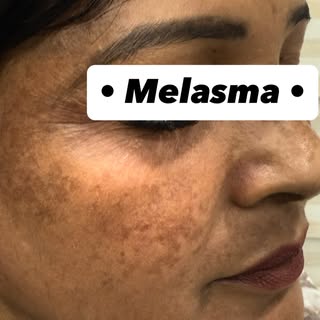 ✨ Struggling with Pigmentation & Melasma? ✨

At Siddhi Skin Clinic, we offer advanced and personaliz