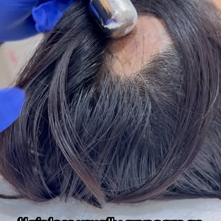 🍃 Alopecia Areata is Treatable – Don’t Ignore Those Bald Patches!

Sudden round patches of hair los