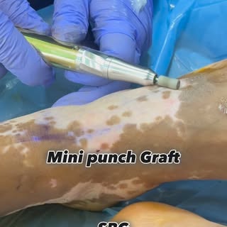 ✨ Vitiligo surgery can restore natural skin color in carefully selected patients.

✔️ Best for stabl