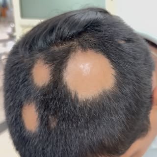 Alopecia Areata? Don’t lose hope! 💙

Advanced, dermatologist-guided treatment for Alopecia Areata a