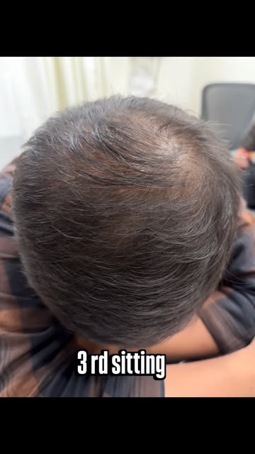 ✨ Dutoxomes Exosomes for Hair Loss ✨

A new-age approach to hair & scalp rejuvenation. 🧬💫

Dutoxom
