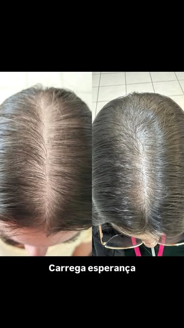 Ela chorou ao ouvir que estava ficando sem cabelo. 🤍

Hoje, essa história está sendo transformada c