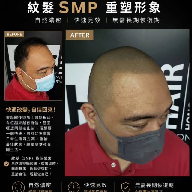 當身邊嘅朋友個個仲有頭髮，自己嘅脫髮問題，有時就更加難忽視。

呢位客人嘅髮線不斷後移，加上頭頂頭髮逐漸稀疏。平時同一班冇脫髮問題嘅朋友見面、聚會，亦令佢越來越在意自己外表上嘅改變。

佢唔想選擇一個