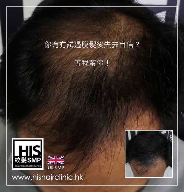 你有冇試過脫髮後失去自信？等我幫你！

你有冇試過照鏡嗰陣，眼光總係第一時間落喺自己後退嘅髮際線或者稀疏嘅頭頂？出街開始「帽不離身」，去到室內又驚強光直射頭皮；同朋友傾計嗰陣，只要對方眼神稍微向上瞟一