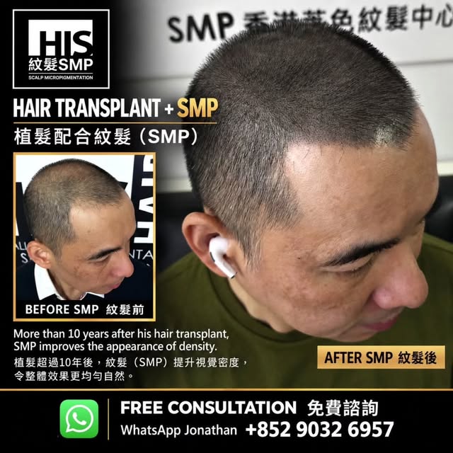 植髮＋紋髮（SMP）— 互相配合，效果更完整

呢位客人喺超過10年前曾經接受植髮，重塑髮線。隨住時間過去，周邊頭髮逐漸變得稀疏，整體視覺密度亦有所下降。

透過細緻嘅紋髮（SMP），減少頭皮外露，令
