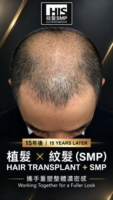 植髮15年後，原有髮線仍然保留，但脫髮已逐漸擴散至接近 Norwood 7。

紋髮（SMP）可以配合現有嘅移植頭髮，填補頭皮明顯位置，將前後視覺自然連接，重塑整體濃密感。

15 years aft