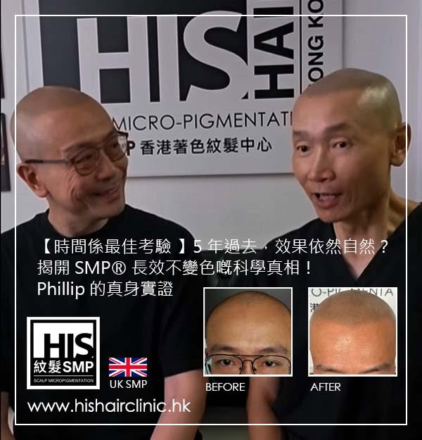 【時間係最佳考驗 ⏳】5 年過去，效果依然自然？揭開 SMP® 長效不變色嘅科學真相！Phillip 的真身實證 ✨

做任何脫髮改善方案，大家心裡最關注嘅問題一定係：「到底可以維持幾耐？幾年後會唔會