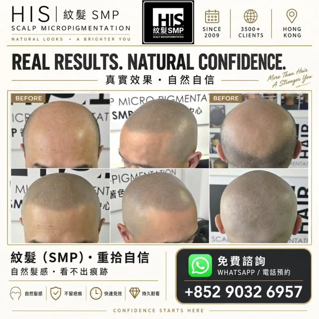 重新投入訓練的自由 💪

這位客人非常慶幸自己認識了紋髮（SMP）。

戴着假髮系統做運動，有時會帶來不少實際困擾。大量出汗可能令假髮移位，頭皮亦容易焗促和痕癢；但在陌生人面前，又不能隨時除下假髮，