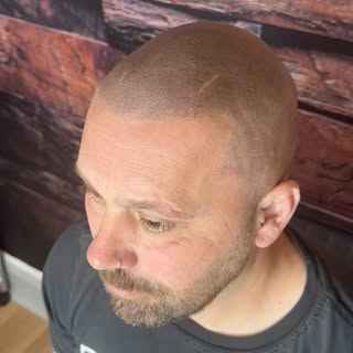 💥Hairline Restoration 💥

💀💀Scalp micropigmentation by Skulltec SW💀💀 @skulltecsw

Guaranteed re