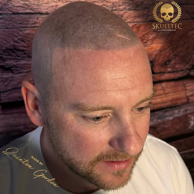 Real client. Real results. No hair? No Problem !
💀

Scalp Micro Pigmentation isn’t a trend. It’s a 