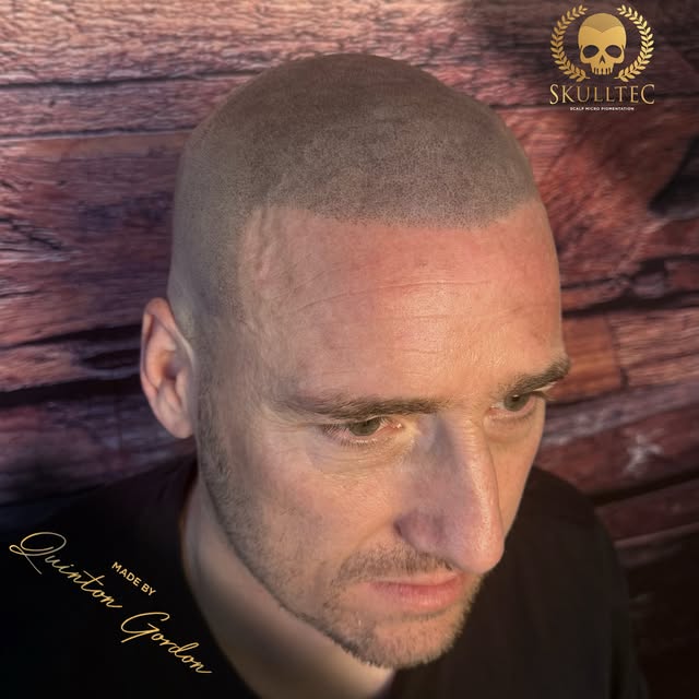 Real client. Real results. No hair? No Problem !
💀

Scalp Micro Pigmentation isn’t a trend. It’s a 