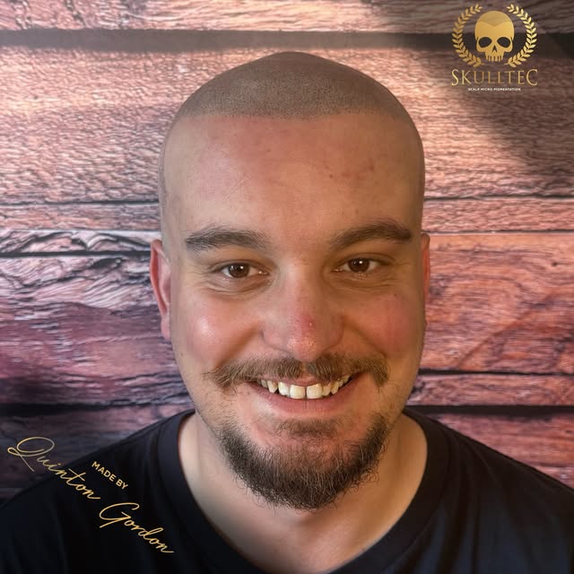 Real client. Real results. No hair? No Problem !
💀

Scalp Micro Pigmentation isn’t a trend. It’s a 