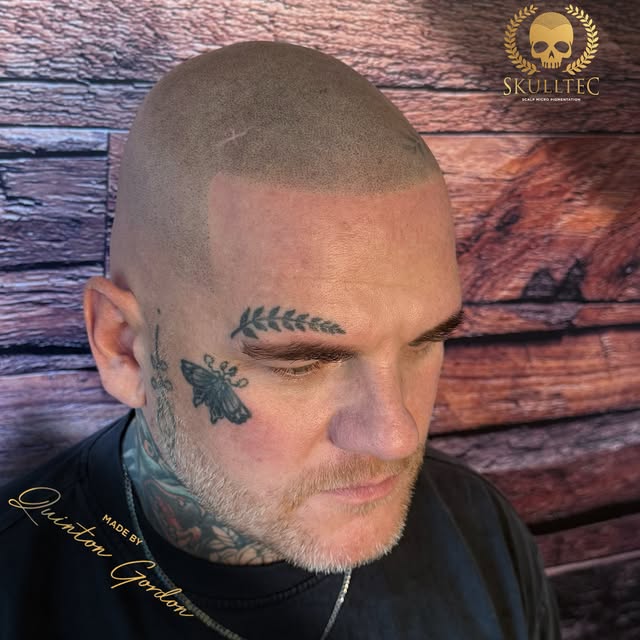 Real client. Real results. No hair? No Problem !
💀

Scalp Micro Pigmentation isn’t a trend. It’s a 