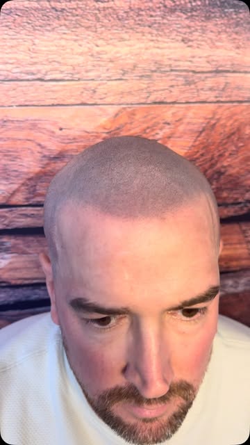 Full shaved head look — sharp, clean, confidently bald 💈

This is what scalp micropigmentation can 