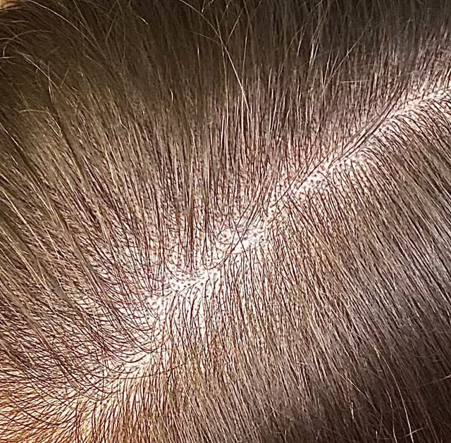Thinning hair has a solution. #thinninghair #smp #hairlosshelp