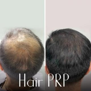Mr. Asif visited us exact 2 months back with his hair loss problem. We have done 3 sessions of Advan