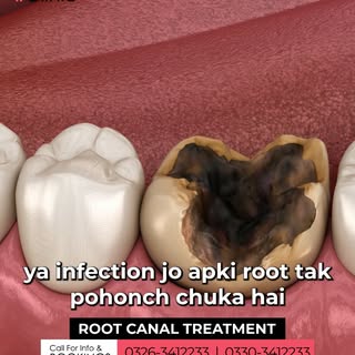 Experiencing severe tooth pain, sensitivity, or discomfort while eating? 🦷 Don’t ignore the signs—y