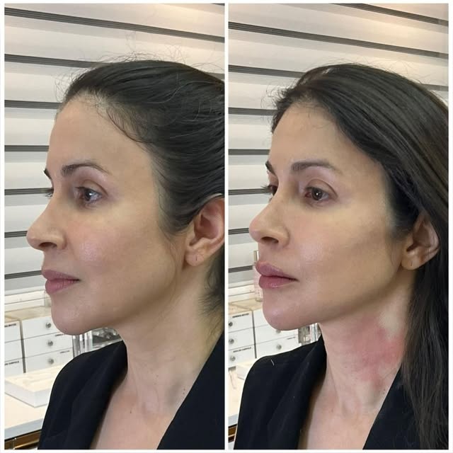 Dermatos também se cuidam e nossa Dra. Priscila já fez os preenchimentos pra ficar linda para o fina