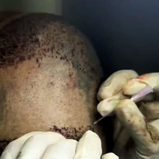 #hairtransformation 
#hairtransplant 
#dermatrchclinics