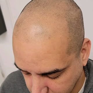 Did you know that you dont need to live with a patchy head due to hair loss? Scalp Micropigmentation