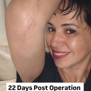 22 days post-op and feeling the positive effects of LED light therapy! It’s been a game-changer in m
