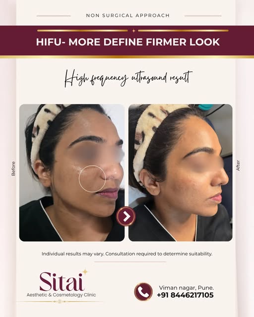 More Defined. Firmer. Naturally Lifted.

Discover HIFU treatment for non-surgical skin lifting and t