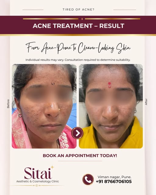 Acne Treatment: Before & After Result

Tired of acne and recurring breakouts?

At Sitai Aesthetic & 