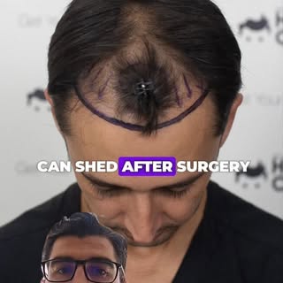 Shock loss after a hair transplant can look scary, but it does not always mean failure.

👨‍⚕️ In th